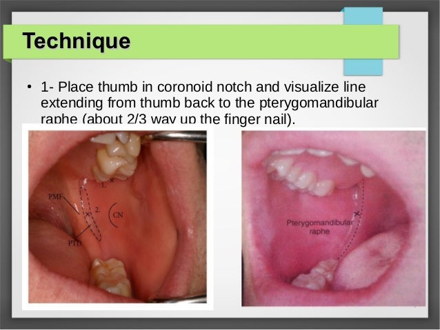 inferior alveolar nerve block