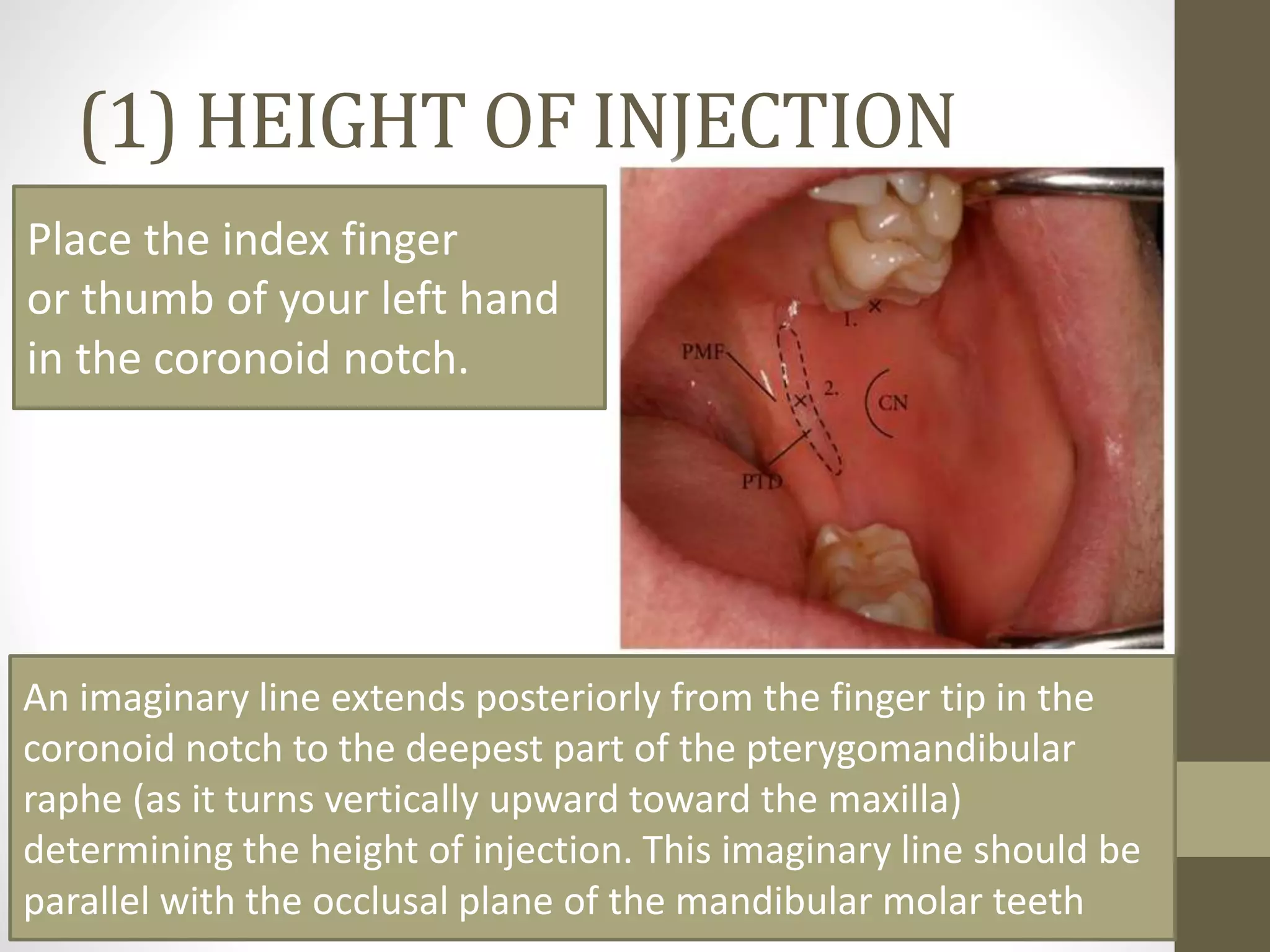 Mandibular Anesthesia : Inferior alveolar nerve block | PPTX
