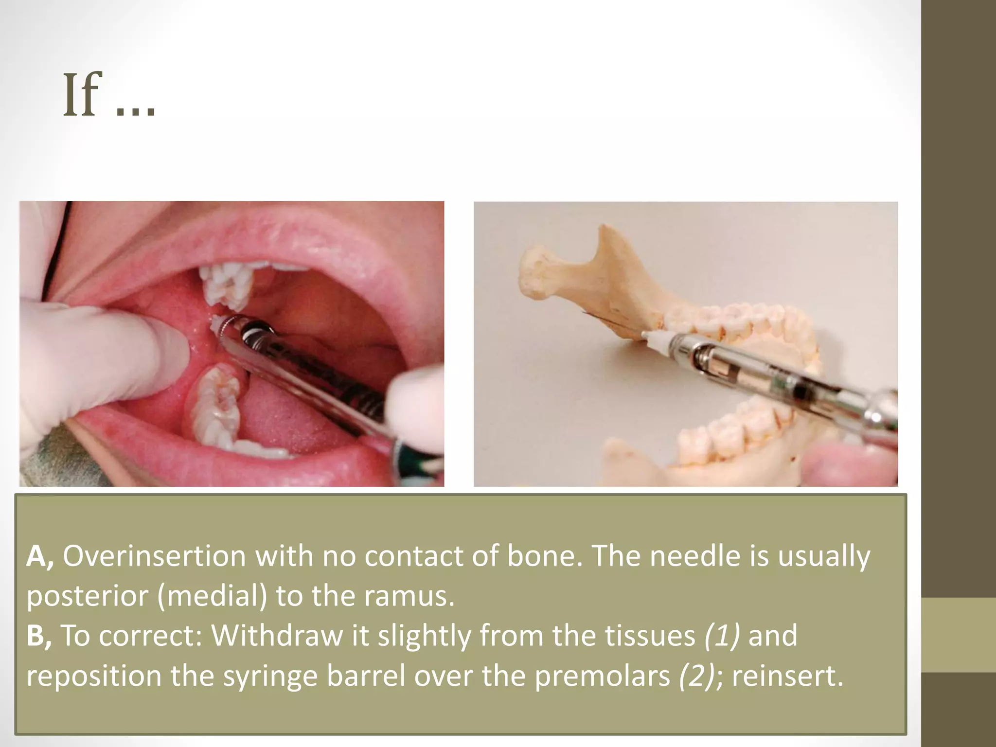 Mandibular Anesthesia : Inferior alveolar nerve block | PPTX