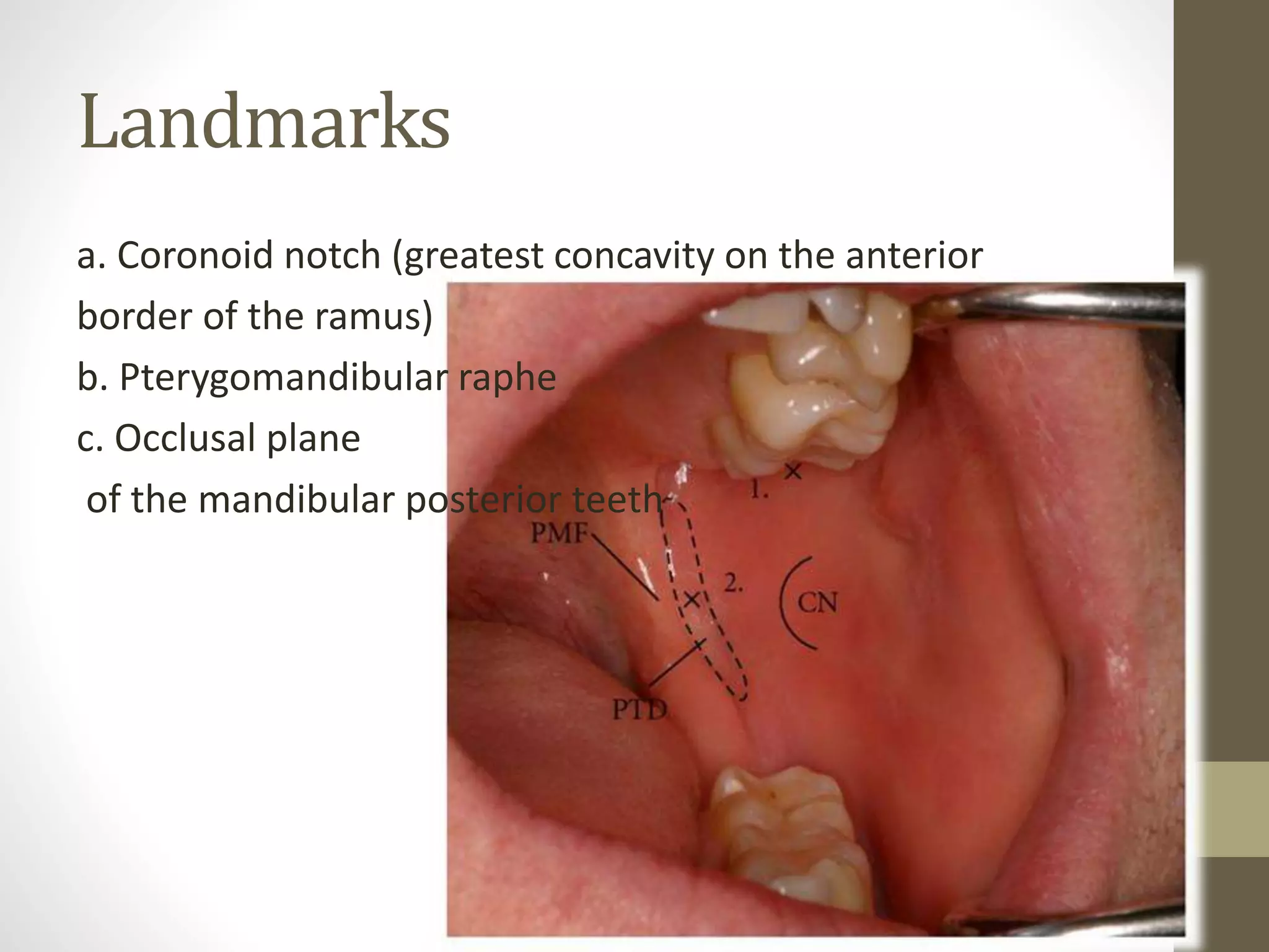 Ia Injection Rafe Coronoid Notch And Pterygomandibular Raphe