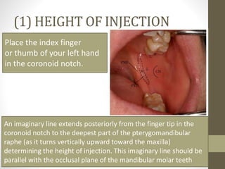 Mandibular Anesthesia : Inferior alveolar nerve block | PPTX