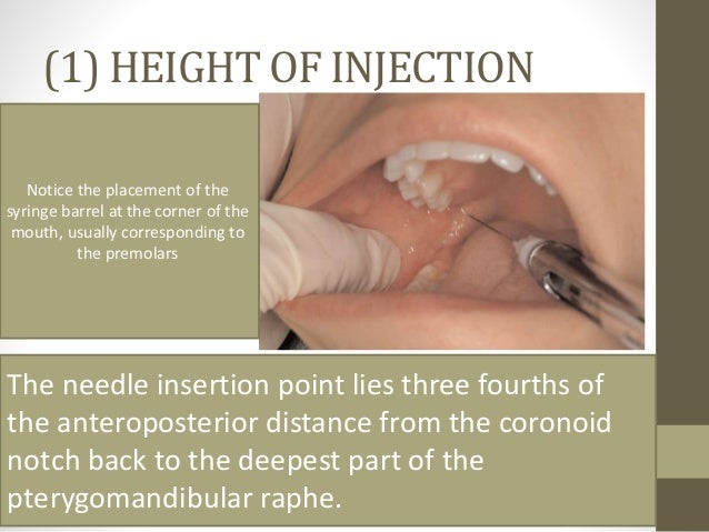 inferior alveolar nerve block