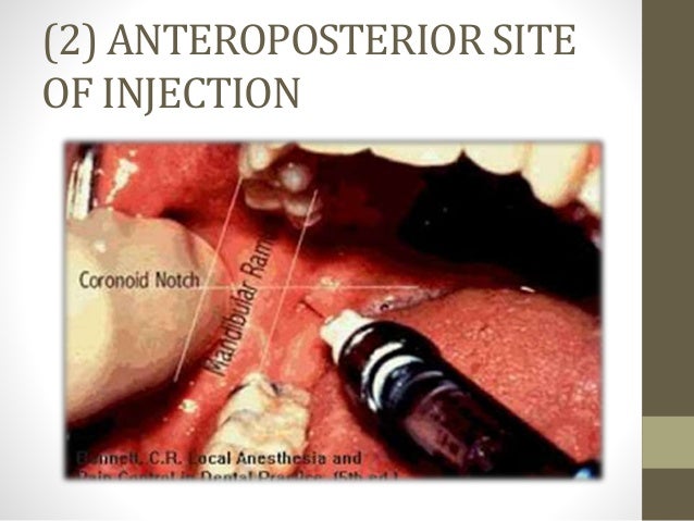 inferior alveolar nerve block