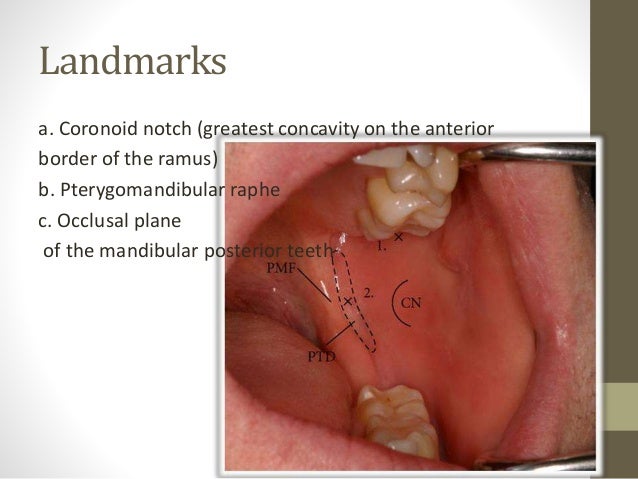 inferior alveolar nerve block