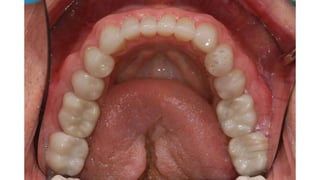 Inferior Alveolar Nerve Block.pptx