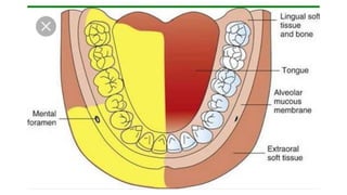 Inferior Alveolar Nerve Block.pptx