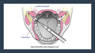Inferior Alveolar Nerve Block.pptx