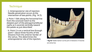 Intersection Injection Comprehensive Guide to Inferior Alveolar Nerve Block Technique and ...