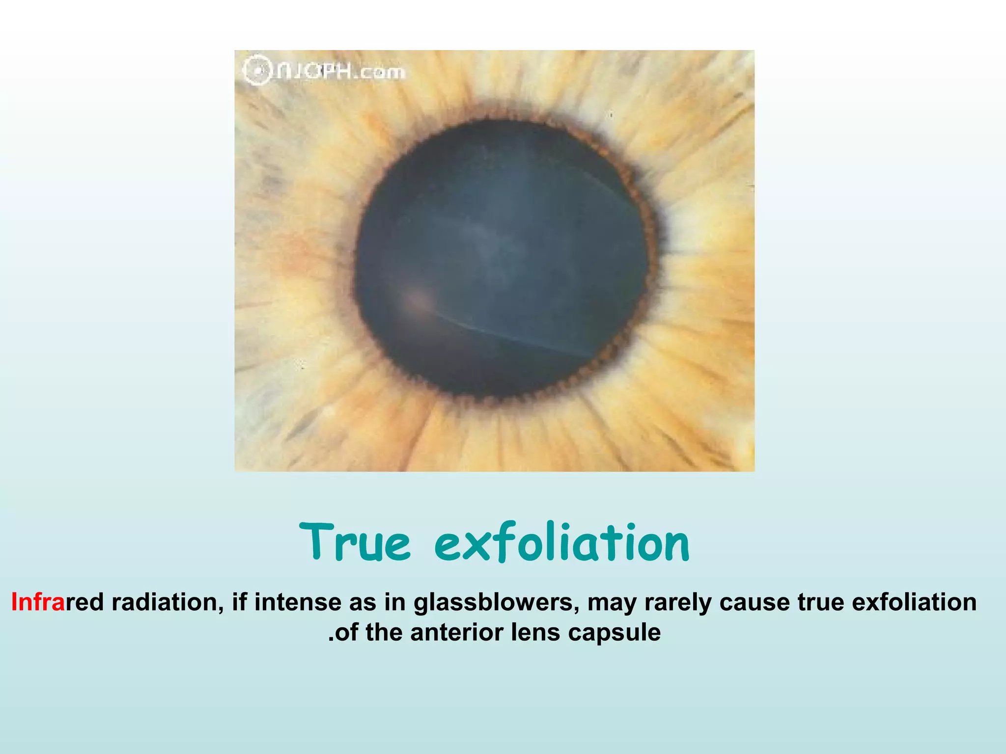 True exfoliation
Infrared radiation, if intense as in glassblowers, may rarely cause true exfoliation
of the anterior lens capsule.
 