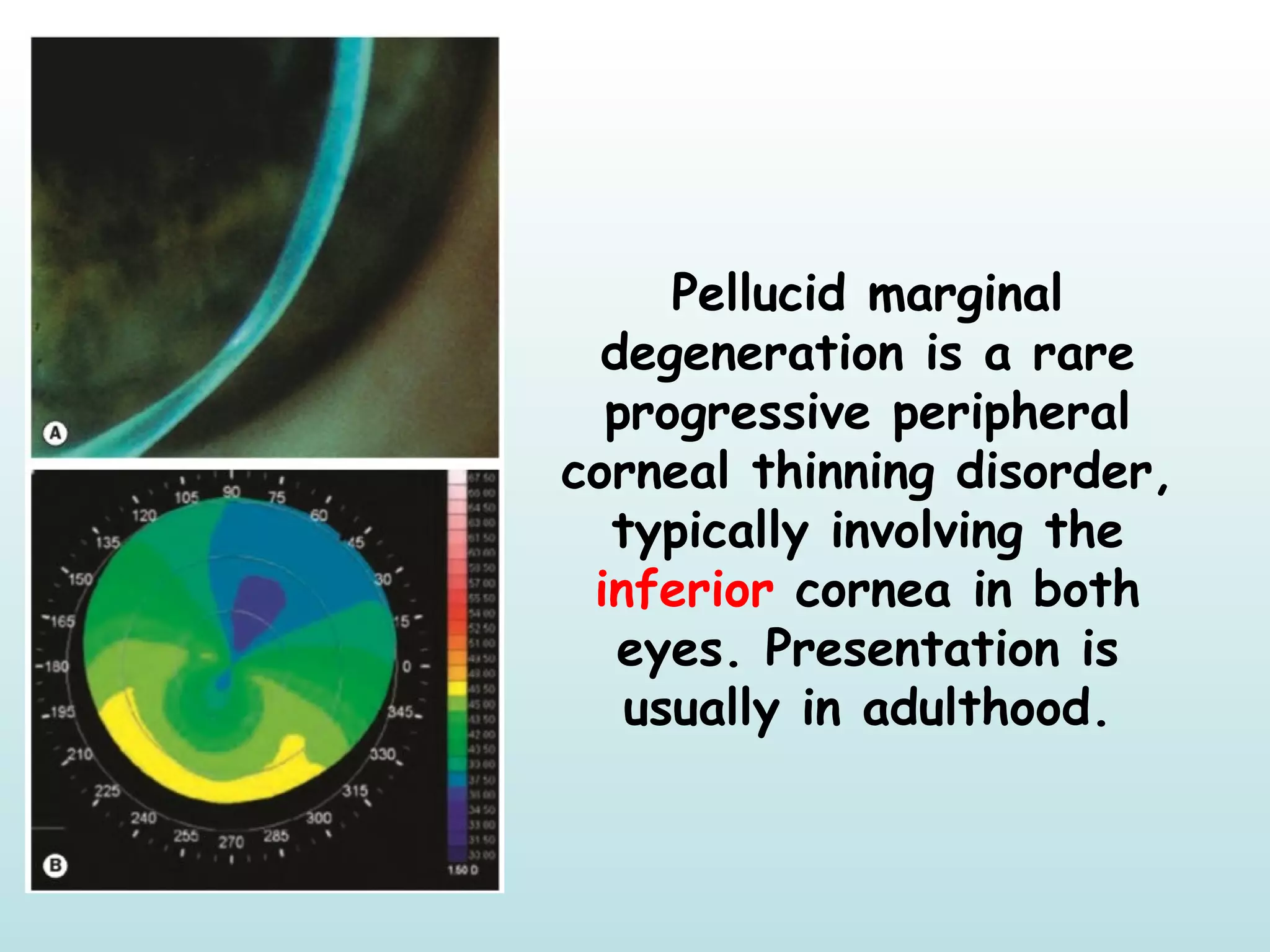 Pellucid marginal
degeneration is a rare
progressive peripheral
corneal thinning disorder,
typically involving the
inferior cornea in both
eyes. Presentation is
usually in adulthood.
 