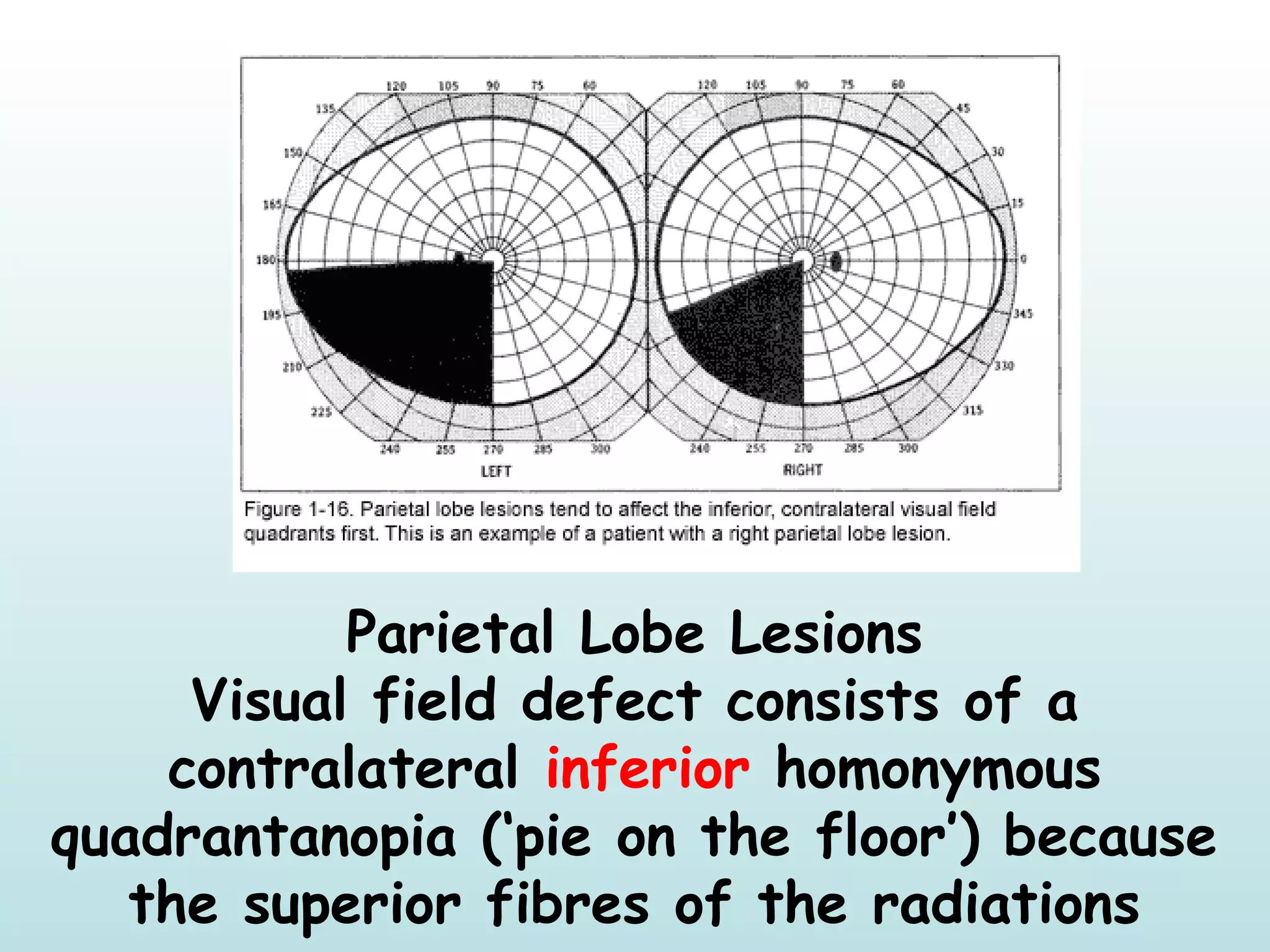 Parietal Lobe Lesions
Visual field defect consists of a
contralateral inferior homonymous
quadrantanopia (‘pie on the floor’) because
the superior fibres of the radiations
 