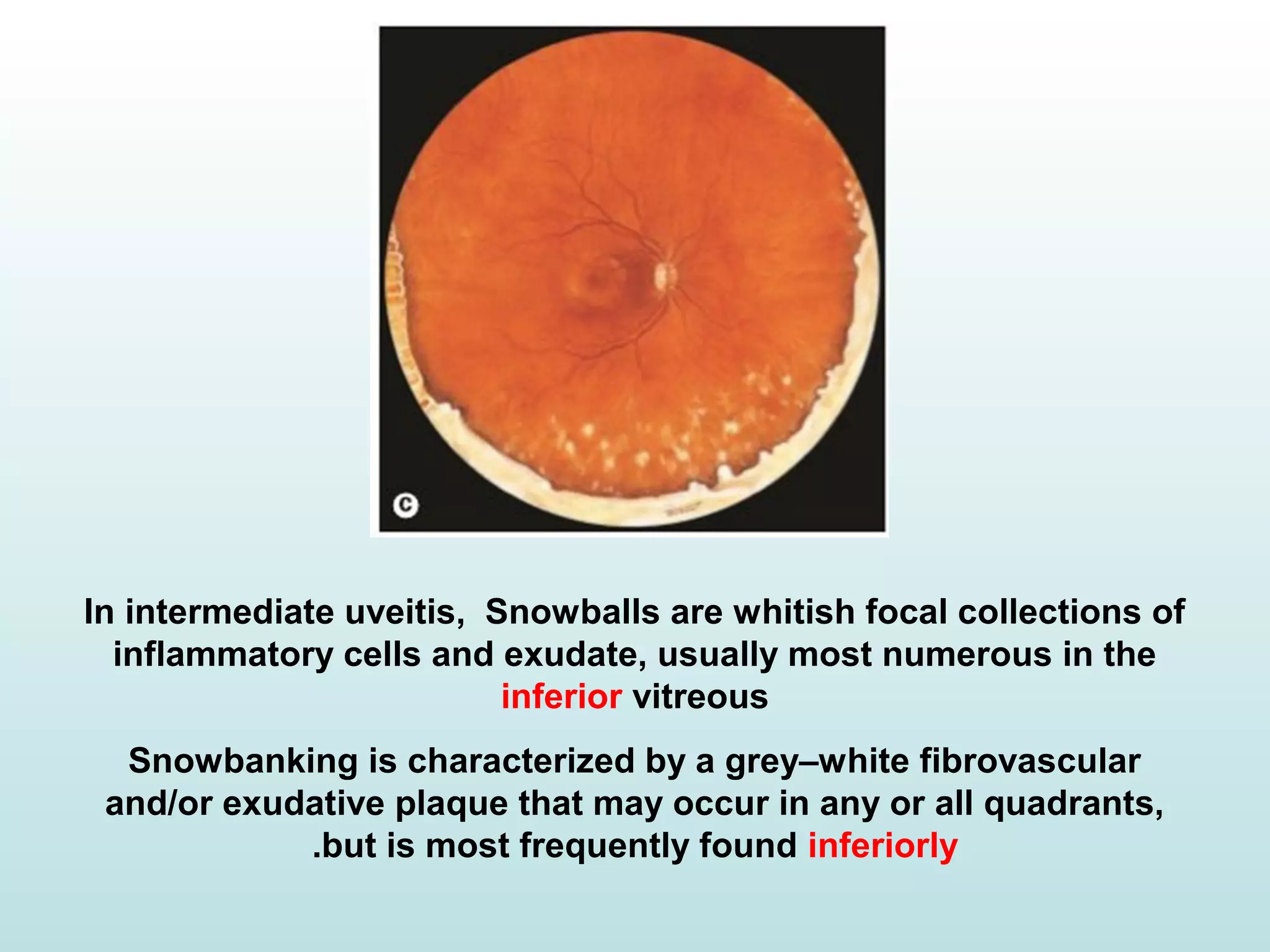 In intermediate uveitis, Snowballs are whitish focal collections of
inflammatory cells and exudate, usually most numerous in the
inferior vitreous
Snowbanking is characterized by a grey–white fibrovascular
and/or exudative plaque that may occur in any or all quadrants,
but is most frequently found inferiorly.
 