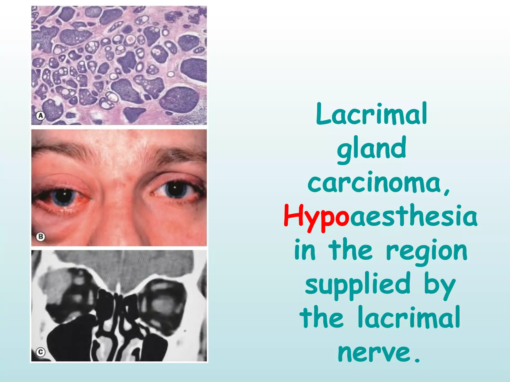 Lacrimal 
gland 
carcinoma,
Hypoaesthesia
in the region
supplied by
the lacrimal
nerve.
 