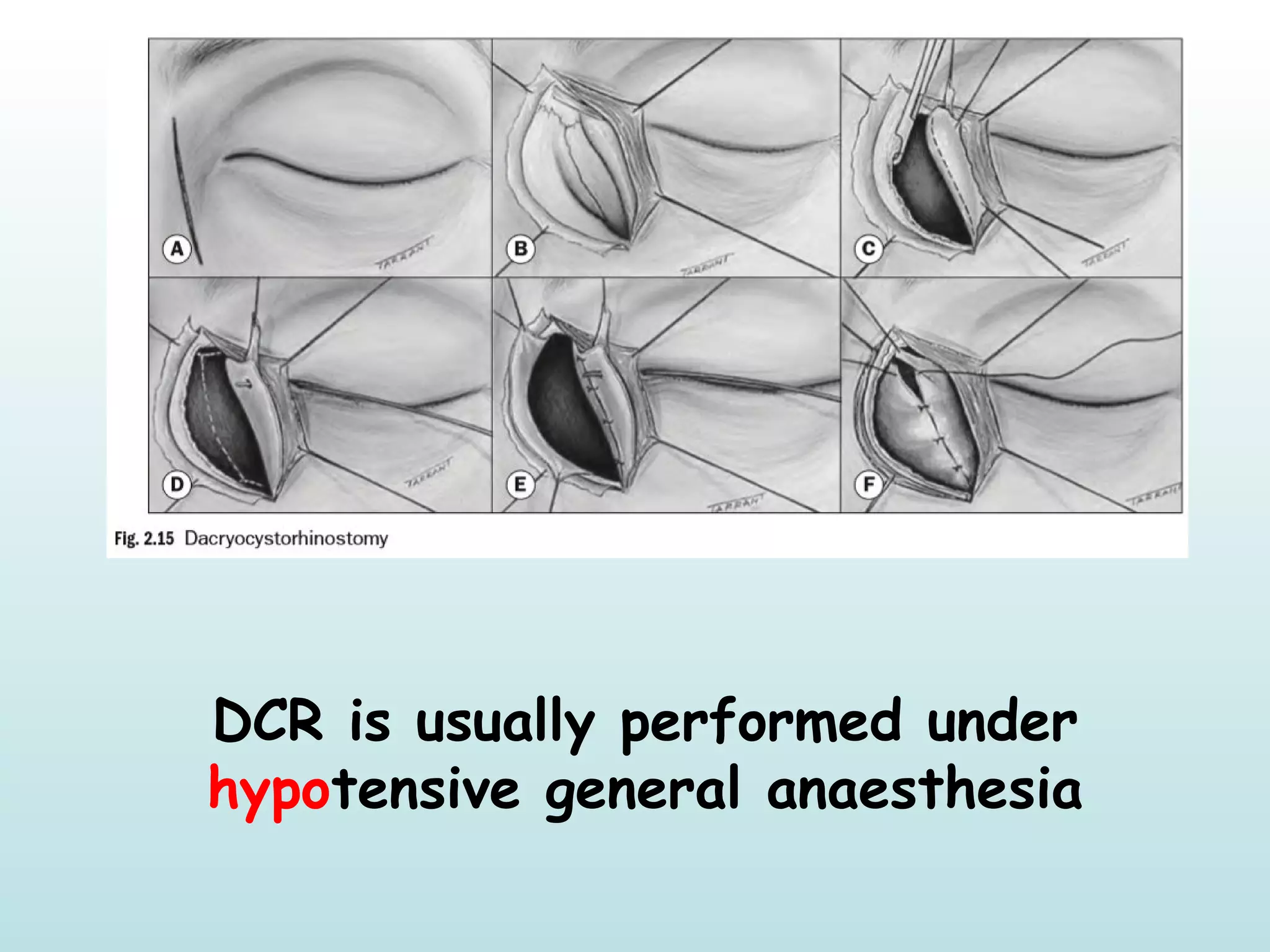 DCR is usually performed under
hypotensive general anaesthesia
 