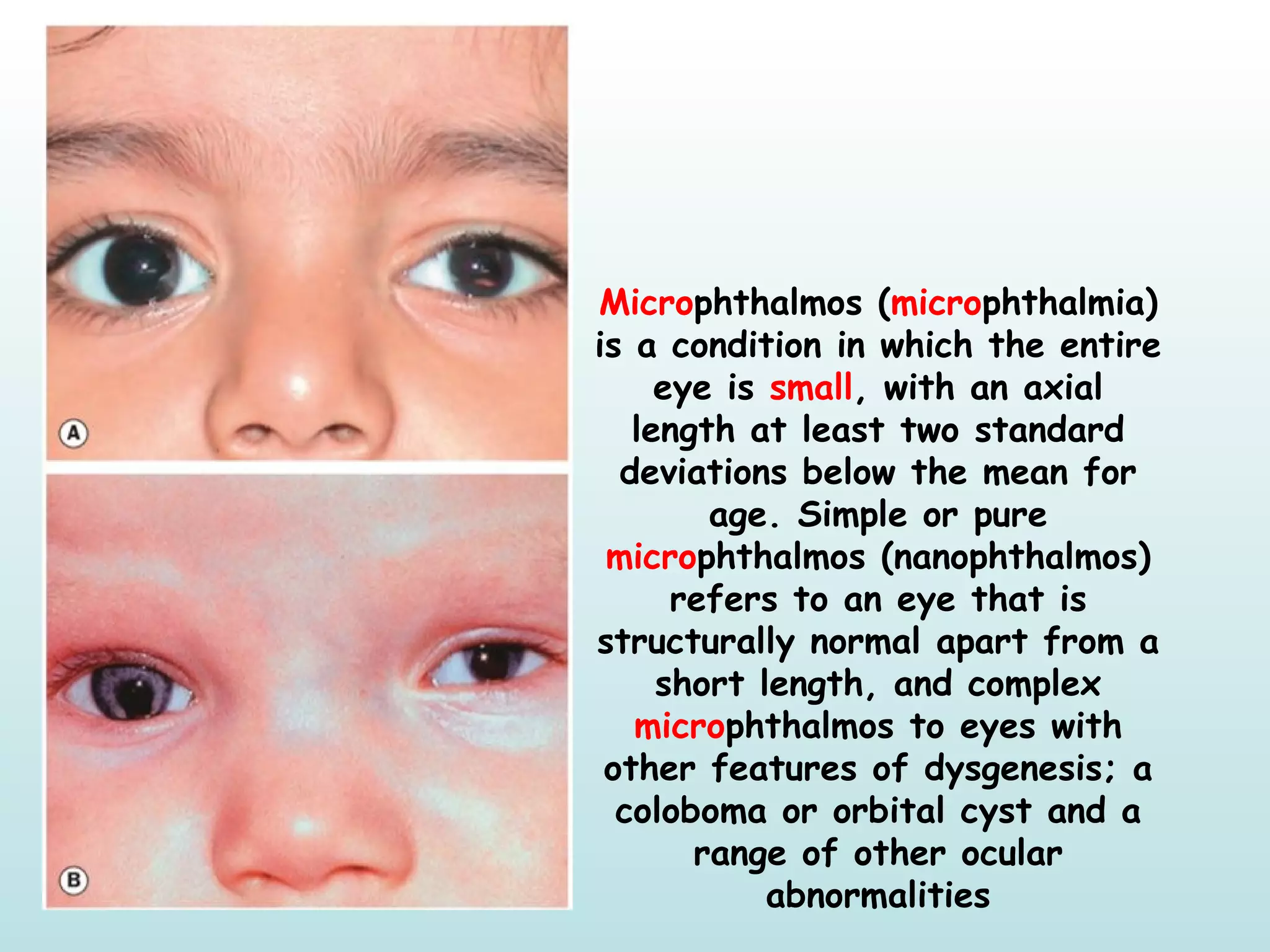 Microphthalmos (microphthalmia)
is a condition in which the entire
eye is small, with an axial
length at least two standard
deviations below the mean for
age. Simple or pure
microphthalmos (nanophthalmos)
refers to an eye that is
structurally normal apart from a
short length, and complex
microphthalmos to eyes with
other features of dysgenesis; a
coloboma or orbital cyst and a
range of other ocular
abnormalities
 