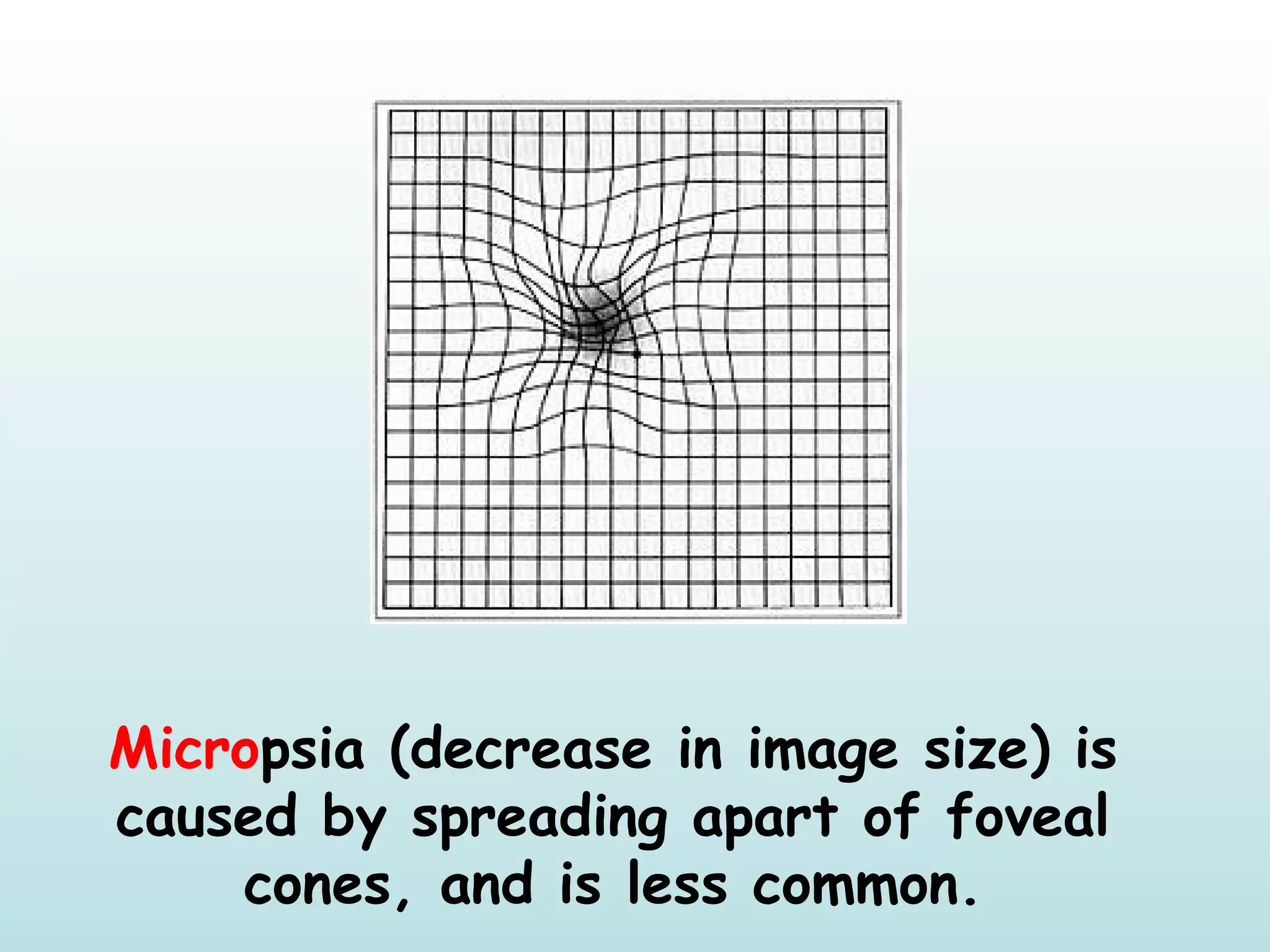 Micropsia (decrease in image size) is
caused by spreading apart of foveal
cones, and is less common.
 