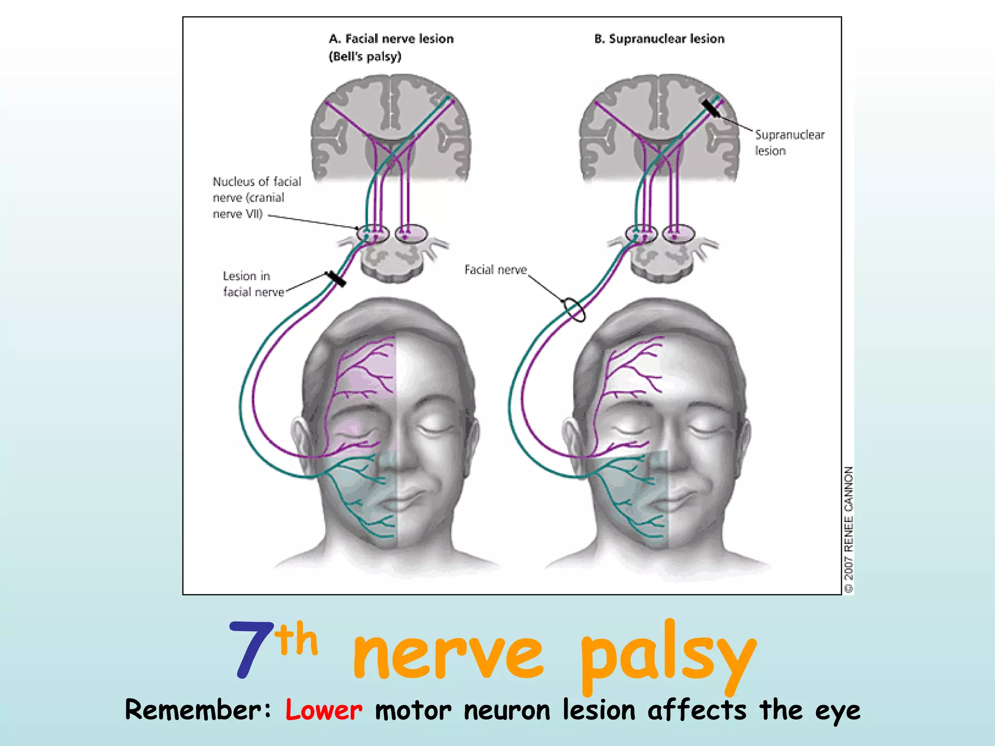7th
nerve palsy
Remember: Lower motor neuron lesion affects the eye
 