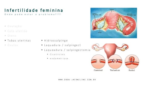 Infertilidade Feminina E Reproducao Assistida Coma 17