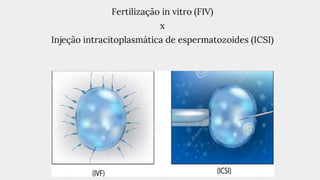 Fertilização in vitro (FIV)
x
Injeção intracitoplasmática de espermatozoides (ICSI)
 