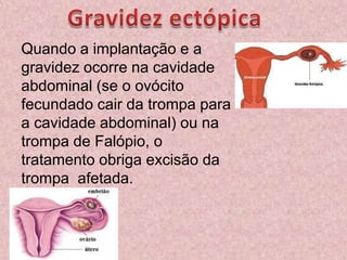 Gravidez ectópicaQuando a implantação e a gravidez ocorre na cavidade abdominal (se o ovócito fecundado cair da trompa para a cavidade abdominal) ou na trompa de Falópio, o tratamento obriga excisão da trompa  afetada.