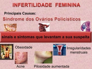 INFERTILIDADE  FEMININAPrincipais Causas:Síndrome dos Ovários Policísticos  sinais e sintomas que levantam a sua suspeitaObesidadeIrregularidades menstruaisPilosidade aumentadaAcne