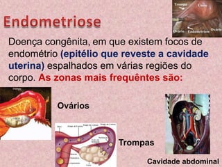 Endometriose  Doença congênita,em que existem focos de endométrio (epitélio que reveste a cavidade uterina) espalhados em várias regiões do corpo. As zonas mais frequêntes são:OváriosTrompasCavidade abdominal