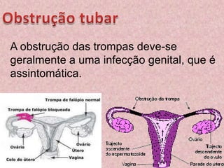 Obstrução tubarA obstrução das trompas deve-se geralmente a uma infecção genital, que é assintomática.
