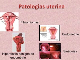 Patologias uterinaFibromiomas.EndometriteSinéquias Hiperplasia benigna do endométrio