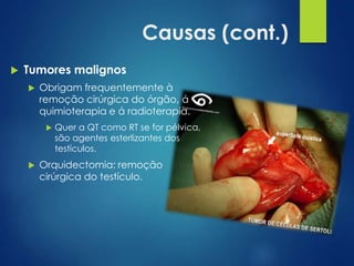 Causas (cont.)


Tumores malignos


Obrigam frequentemente à
remoção cirúrgica do órgão, á
quimioterapia e á radioterapia.




Quer a QT como RT se for pélvica,
são agentes esterlizantes dos
testículos.

Orquidectomia: remoção
cirúrgica do testículo.

 