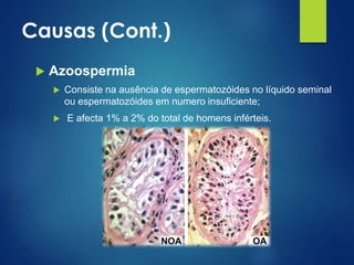 Causas (Cont.)


Azoospermia




Consiste na ausência de espermatozóides no líquido seminal
ou espermatozóides em numero insuficiente;
E afecta 1% a 2% do total de homens inférteis.

 