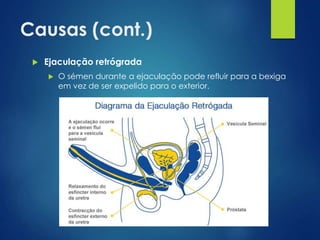 Causas (cont.)


Ejaculação retrógrada


O sémen durante a ejaculação pode refluir para a bexiga
em vez de ser expelido para o exterior.

 