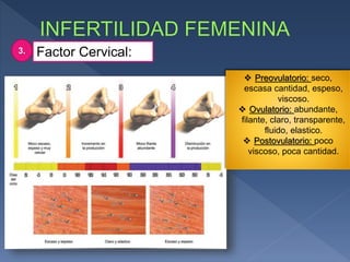 Factor Cervical:3.
 Preovulatorio: seco,
escasa cantidad, espeso,
viscoso.
 Ovulatorio: abundante,
filante, claro, transparente,
fluido, elastico.
 Postovulatorio: poco
viscoso, poca cantidad.
 