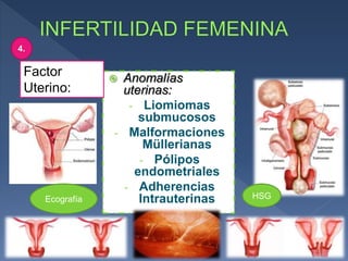  Anomalías
uterinas:
- Liomiomas
submucosos
- Malformaciones
Müllerianas
- Pólipos
endometriales
- Adherencias
Intrauterinas
Factor
Uterino:
4.
Ecografía HSG
 
