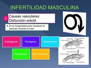 Causas vasculares:
Disfunción eréctil.
3.
 Es la incapacidad para mantener la
erección durante el coito.
Andrógenos. Psicógeno. Alcoholismo.
Nefropatías. Aterosclerosis.
 