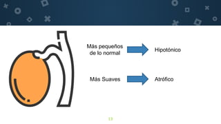 13
Más pequeños
de lo normal
Más Suaves
Hipotónico
Atrófico
 