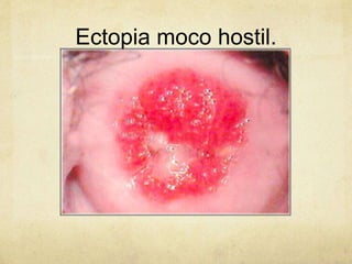 Ectopia moco hostil.
 