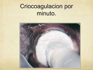 Criocoagulacion por
minuto.
 