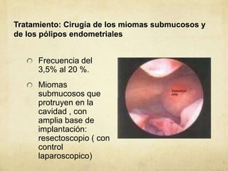 Tratamiento: Cirugía de los miomas submucosos y
de los pólipos endometriales
Frecuencia del
3,5% al 20 %.
Miomas
submucosos que
protruyen en la
cavidad , con
amplia base de
implantación:
resectoscopio ( con
control
laparoscopico)
 