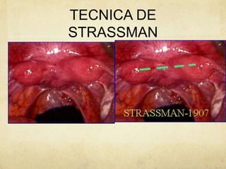 TECNICA DE
STRASSMAN
 