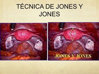 TÉCNICA DE JONES Y
JONES
 