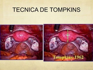 TECNICA DE TOMPKINS
 
