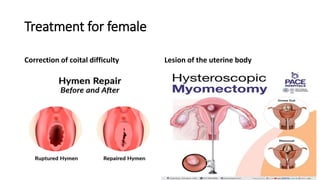 Treatment for female
Correction of coital difficulty Lesion of the uterine body
 