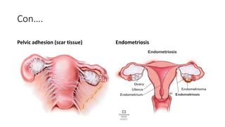 Con….
Pelvic adhesion (scar tissue) Endometriosis
 