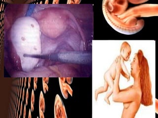 Hysterosalphingopraphy