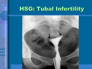 Acquired DisordersAcute salpingitisAlters the functional integrity of the fallopian tubeN. gonorrhea and C. trachomatisIntrauterine scarring Can be caused by curettageEndometriosis, scarring from surgery, tumors of the uterus and ovaryFibroids, endometriomasTrauma