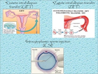 •Gamete intrafallopian
transfer (GIFT)
•Zygote intrafallopian transfer
(ZIFT)
•Intracytoplasmic sperm injection
(ICSI)
 