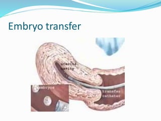 Embryo transfer
 