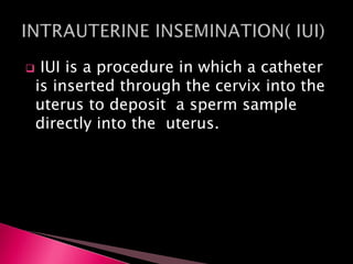  IUI is a procedure in which a catheter
is inserted through the cervix into the
uterus to deposit a sperm sample
directly into the uterus.
 