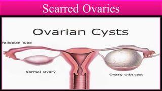 Scarred Ovaries
 