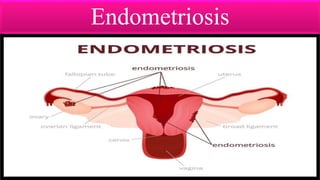 Endometriosis
 